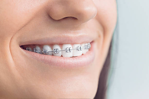 Best Invisalign and Clear Aligners  in Queensland, MD